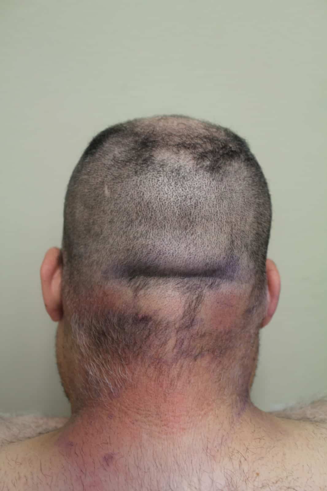 Patient with NW 3 level hair loss, FUE Shave test positive, nape and periauricular hair shows gradual progression from the mid occipital zone in terms of density, and hair caliber with no clear line of demarcation