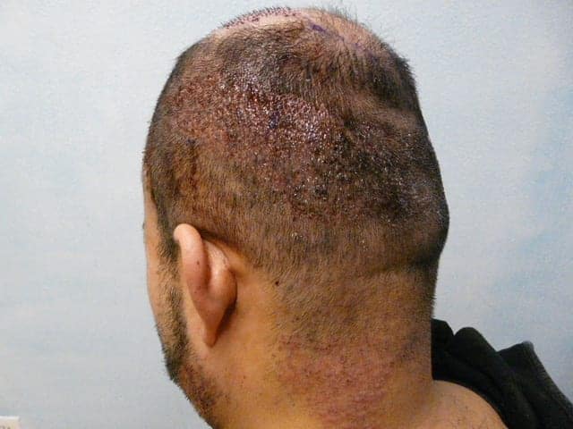 Patient with NW 4-5 level hair loss (Left Side view), FUE Shave test negative. Nape and periauricular hair are avoided in FUE. FUE is confine to the zones above the line of demarcation in area of higher hair density and caliber. Neck hair which is unaffected and technically part of body hair is extracted optimally.