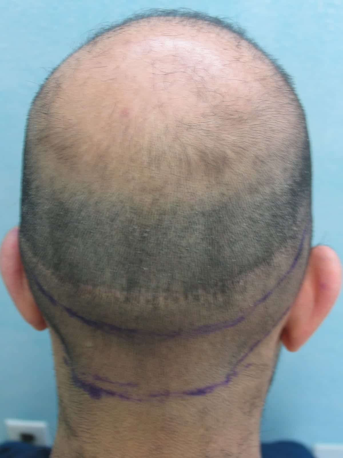 Patient with NW 7 and retrograde hair loss (back view), FUE Shave test negative, nape and periauricular hair shows a precipitous fall from the mid occipital zone in terms of density, and hair caliber with a discernible line of demarcation. It also shows how a strip surgery scar taken using traditional SDA landmarks now lies in area of retrograde alopecia while his area of permanent hair well delineated by the FUE shave test is untouched. This shows the inaccuracy of the traditional SDA landmarks and the dynamic nature of the shifting true SDA which the FUE shave test is able to accurately define consistently.Also note how his occipital notch which would have fallen within the traditional safe donor zone is clearly in the retrograde alopecia zone in this FUE shave test illustration