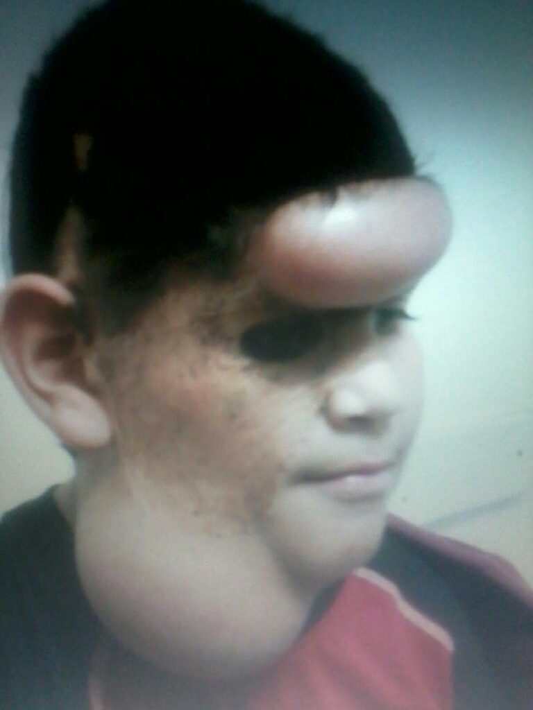 Patient shown undergoing balloon expansion which aims to stretch the skin and create extra tissue for replacing the congenital nevus mole areas on the face Patient shown undergoing balloon expansion which aims to stretch the skin and create extra tissue for replacing the congenital nevus mole areas on the face