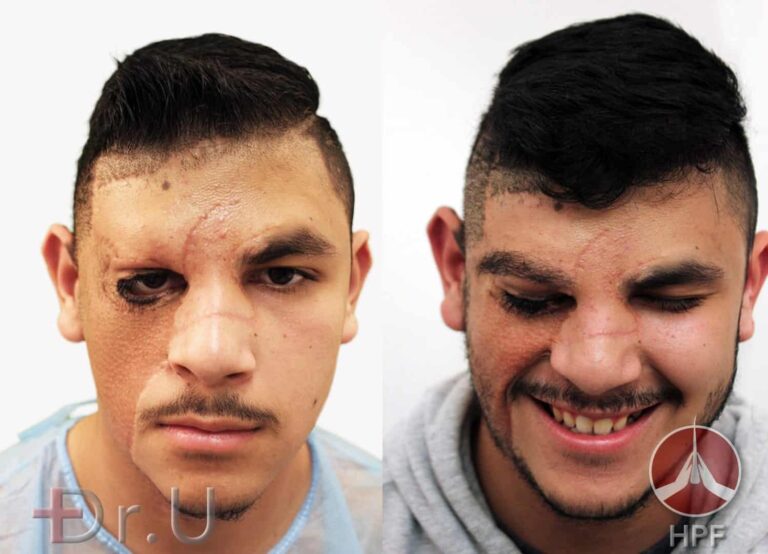 Los Angeles eyebrow and beard hair restoration - before and after photos showing the results of nape and leg hair transplant Los Angeles eyebrow and beard hair restoration - before and after photos showing the results of nape and leg hair transplant