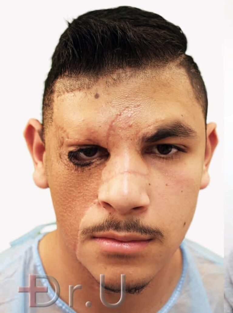 Alex before his facial hair restoration for the right eyebrow and bear Alex before his facial hair restoration for the right eyebrow and bear