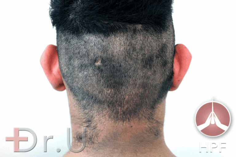Dr.U's FUE Shave Test is a diagnostic assessment which observes hair distribution patterns on a patient's shaved head to determine regions of permanent donor grafts. The evenness of hair shown here shows that this patient qualifies for the use of nape hair grafts as a long-term choice