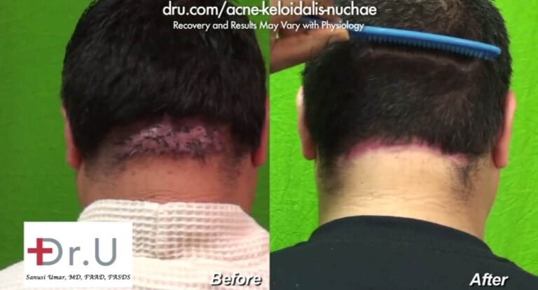 AKN patient's posterior hairline scar is discrete, helping him feel more confident in social situations