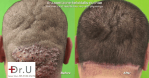 Removing large Acne Keloidalis Nuchae bumps can be achieved through Dr.U's bat excision methods along with tension sutures