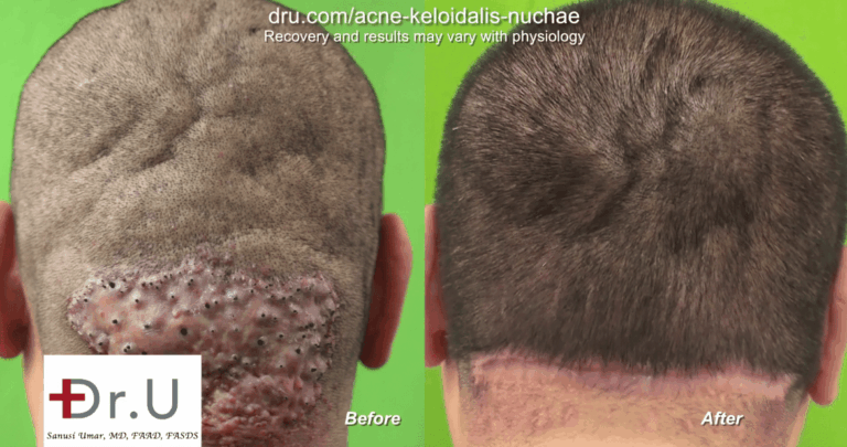 In this instance, secondary intention healing was used, allowing the wound to heal without suturing the edges together. Unlike the conventional context of secondary intention healing, the wound edges are brought together instead of allowing the process of granulation tissue to develop 