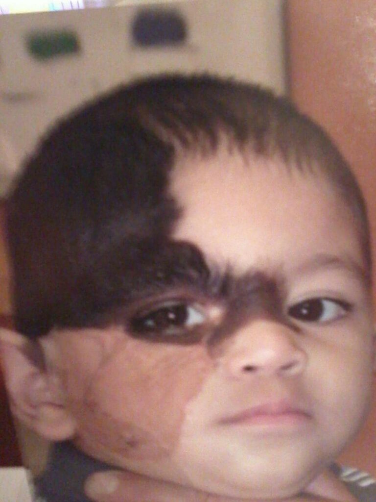 Los Angeles patient was born with a congenital nevus, undergoing several plastic surgeries to remove sections of the darkened skin. Los Angeles patient was born with a congenital nevus, undergoing several plastic surgeries to remove sections of the darkened skin.