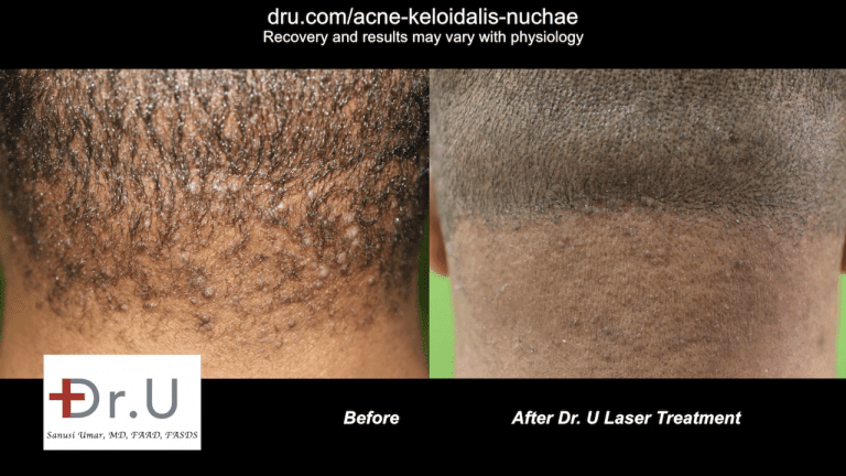 Patient before and after laser treatment for early-stage Acne Keloidalis Nuchae