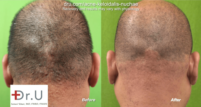Dr.U's laser approach to treating Acne Keloidalis Nuchae involves the targeting of all the hair follicles within a defined treatment zone.*