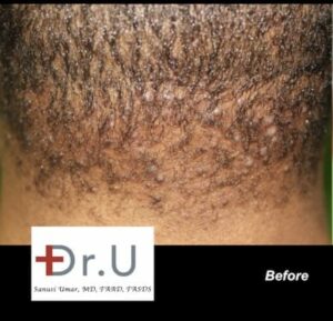 Acne Keloidalis Nuchae bumps in their initial stage*