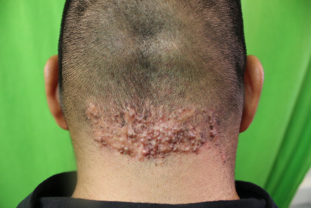 AKN Bumps - Note the plaquelike growth of acne keloidalis nuchae on the back of this patient's neck.