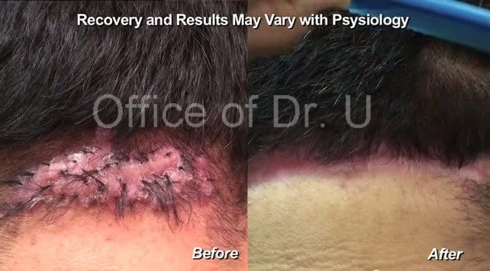 Dr. U surgically excised this patient's case of AKN, using his unique excision methods with suture-assisted 2nd intention healing for the wound to heal into an aesthetically acceptable scar.* Dr. U surgically excised this patient's case of AKN, using his unique excision methods with suture-assisted 2nd intention healing for the wound to heal into an aesthetically acceptable scar.*