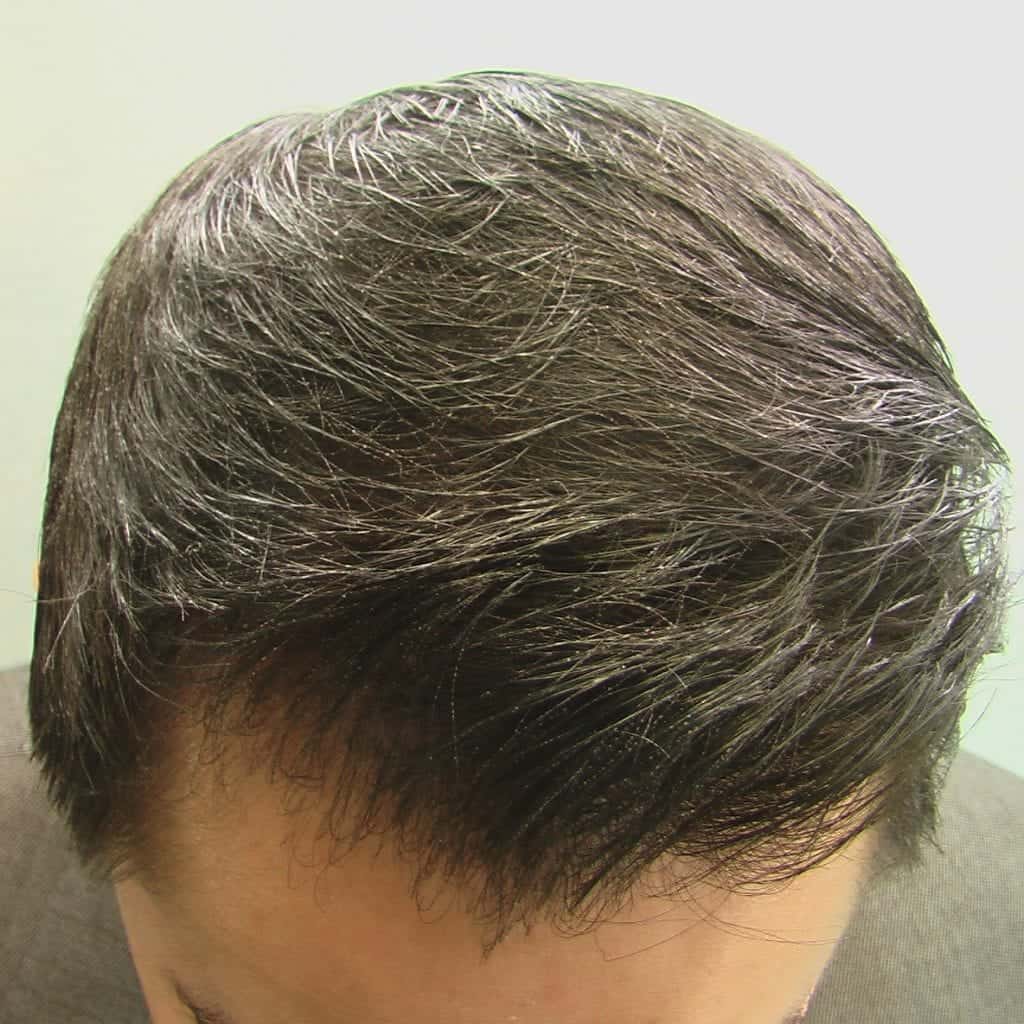 Asian hairline restoration using Dr UGraft in Los Angeles Asian hairline restoration using Dr UGraft in Los Angeles