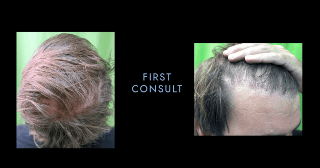 hair transplant before and after
