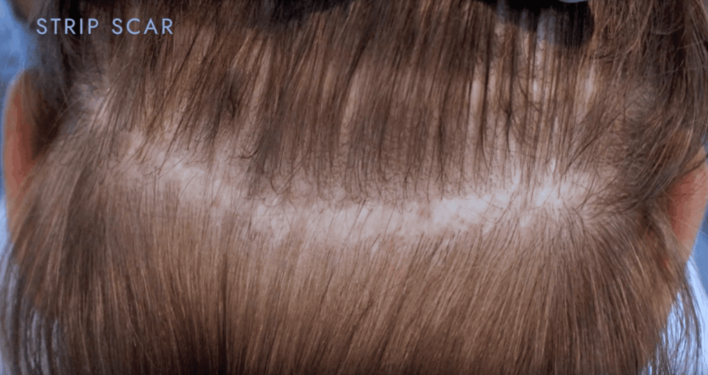 Strip scar still visible from past procedure