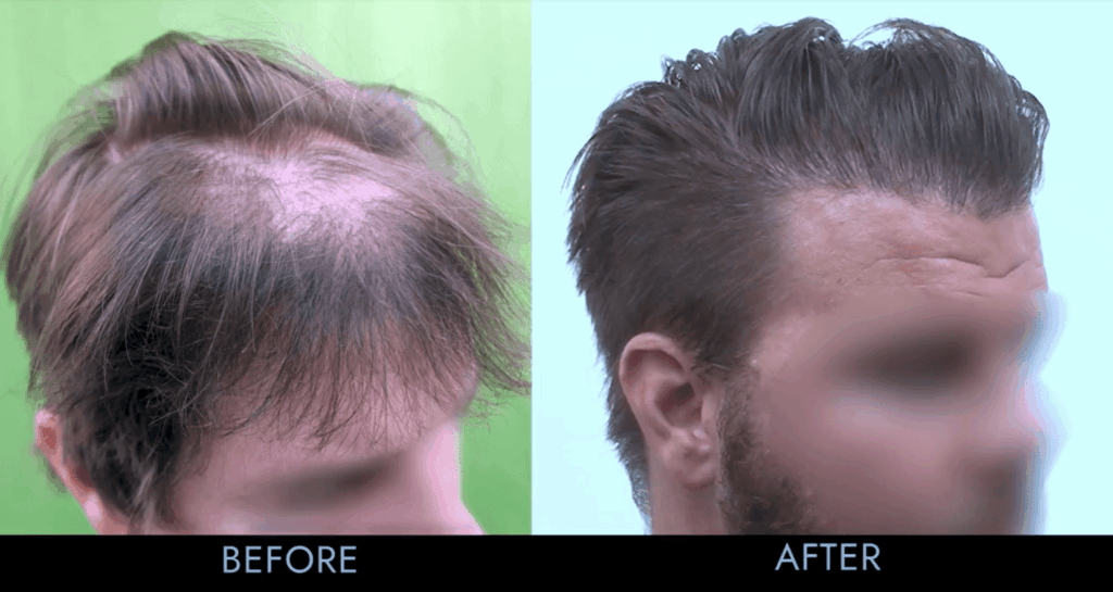 Patient's botched results required a hair transplant repair performed by Dr. U