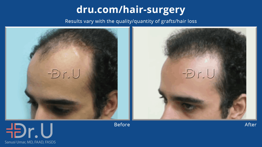 This company CEO dd not want his trans[plant to be obvious to his staff, to achieve this Dr U performed his signature subtle hair transplant surgery