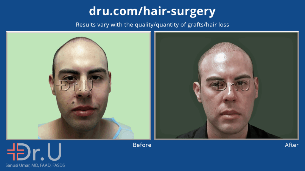 Young patient looking for Subtle hair Restoration for budgetary reasons: Front facing view shows this young patient's new soft, subtle hairline and the difference it made in his overall appearance