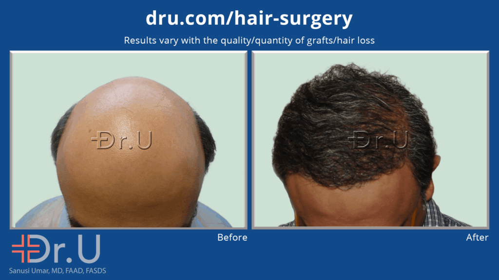Severely bald patient achieves the appearance of full coverage and an aggressive hairline thanks to Dr.U's body hair transplant *