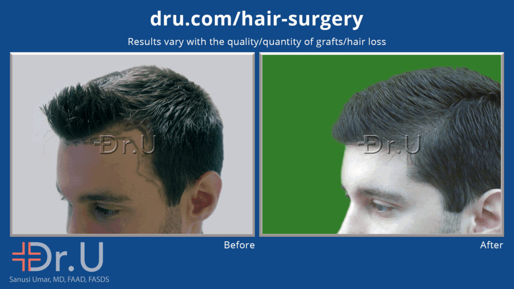 Dr.U reduces forehead size appearance by creating a more aggressive hairline and temples