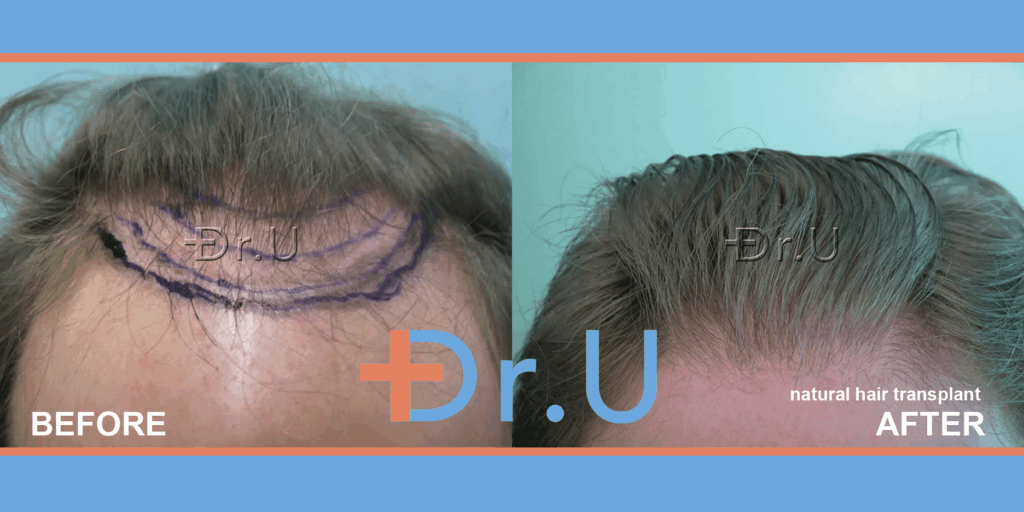 To meet patient's goal for retaining his Norwood 3 but yet fuller hair loss level, Dr U did a subtle hair restoration for a mature hair transplant coverage On the left, the planning degree of hairline advancement is shown. Dr U's Subtle hair transplant was used to achieve his goal of remaining a Norwood 3 but with a fuller look as seen on the right*