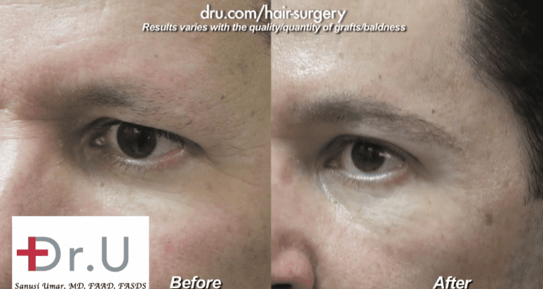 Dr.UGraft ™ technology can be used to transplant nape, leg and other suitable hair types to create thicker eyebrows in men, as well as women.