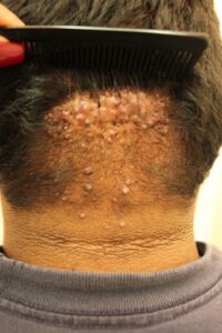 AKN bumps - back of head