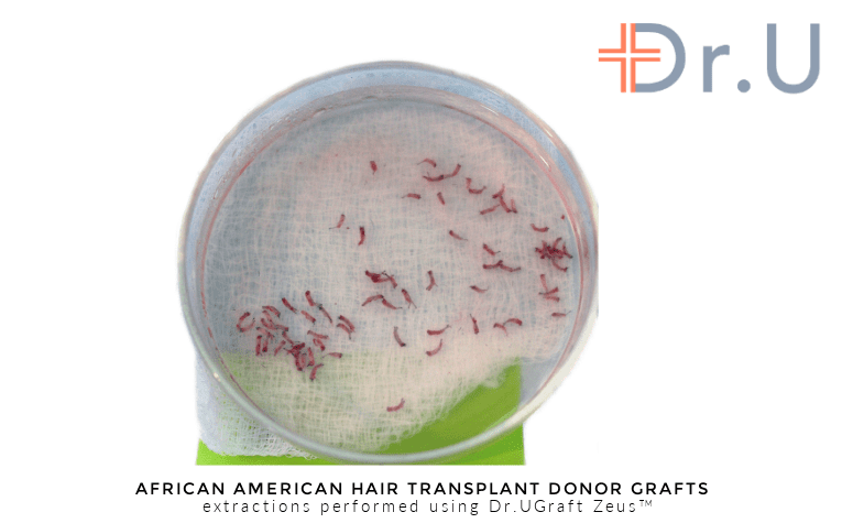 Hair transplant donor grafts harvested using the Intelligent Punch unit of the Dr.UGraft Zeus hair restoration system, invented by Dr.U Hair transplant donor grafts harvested using the Intelligent Punch unit of the Dr.UGraft Zeus hair restoration system, invented by Dr.U