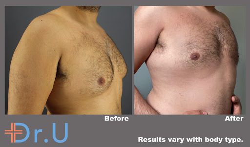 Three quarter's view from the right side shows a significant reduction of this patient's male breasts following his procedure *