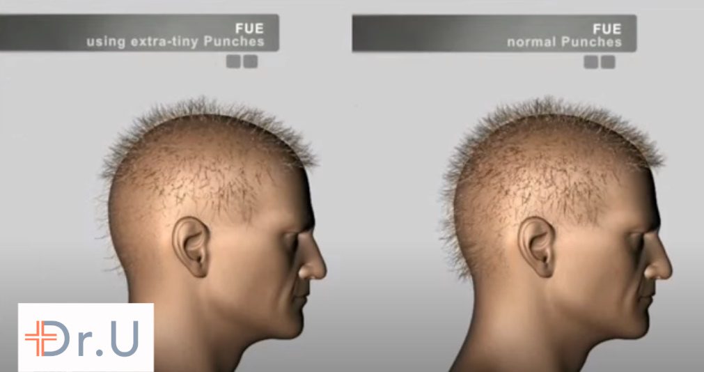 Partial FUE Does Not Multiply Hair