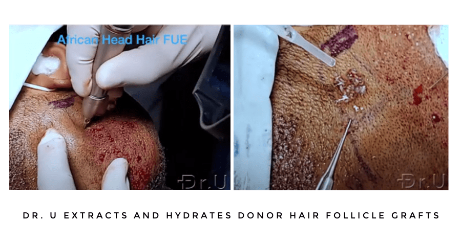 Dr.U performs highly specialized extractions required for the skin thickness of black patients. He and his team also work to keep the donor follicles hydrated. Air exposure is considered the leading cause of hair transplant graft failure Dr.U performs highly specialized extractions required for the skin thickness of black patients. He and his team also work to keep the donor follicles hydrated. Air exposure is considered the leading cause of hair transplant graft failure