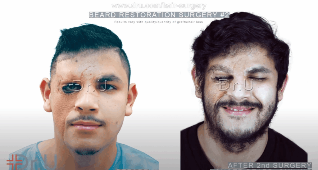 Patient shown before his beard restoration and after his second procedure*
