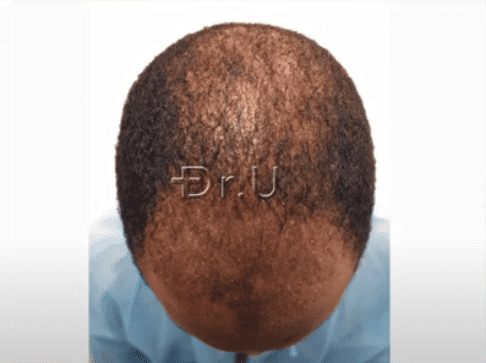 Top view of patient's head at the Norwood 5 hair loss level Top view of patient's head at the Norwood 5 hair loss level