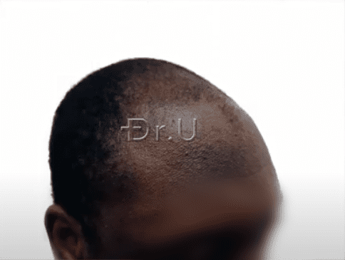 Right view of black male patient's receded temples Right view of black male patient's receded temples