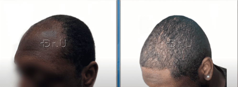 Left side view of black male patient's new hairline and temples. He now sports an age-appropriate appearance thanks to his hair transplant procedure performed by Dr. U Left side view of black male patient's new hairline and temples. He now sports an age-appropriate appearance thanks to his hair transplant procedure performed by Dr. U