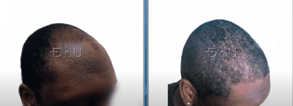 Before and after photos depict fuller coverage and well-designed temples, shown on the right side of this patient's face Before and after photos depict fuller coverage and well-designed temples, shown on the right side of this patient's face