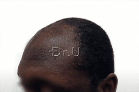 Left view of black male patient's receded temples Left view of black male patient's receded temples