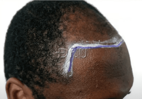 Dr.U designates new temple contours shown on the right side of the patient's face Dr.U designates new temple contours shown on the right side of the patient's face