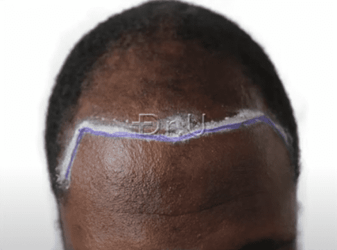 Dr.U planned a new hairline and temples to frame the patient's face and help him achieve a much younger looking appearance. Dr.U planned a new hairline and temples to frame the patient's face and help him achieve a much younger looking appearance.