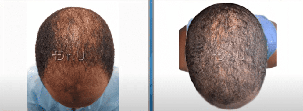Top of black male patient's head now has more coverage through the use of just 3000 grafts Top of black male patient's head now has more coverage through the use of just 3000 grafts