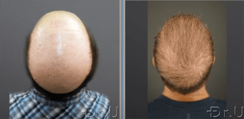 Patient's crown now has a natural-looking whorl 