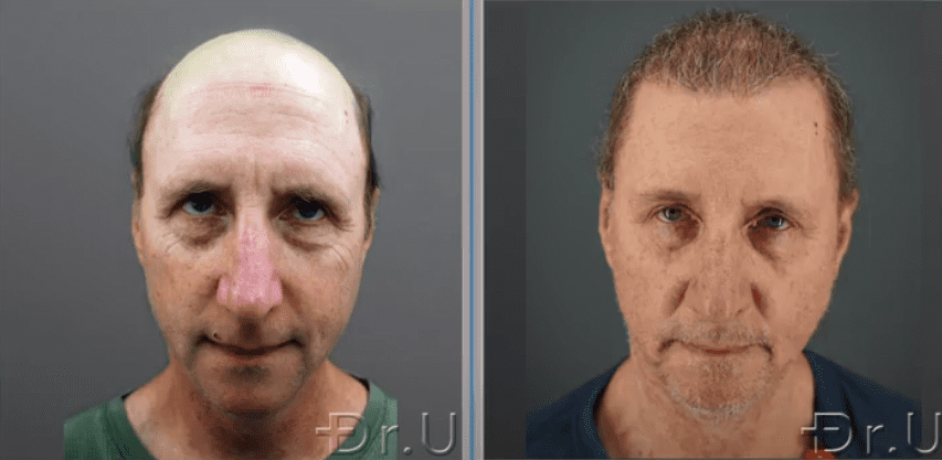 Before and after photos show the front view of Dr. U's patient at 8 months following his Dr.UGraft Zeus procedure.*