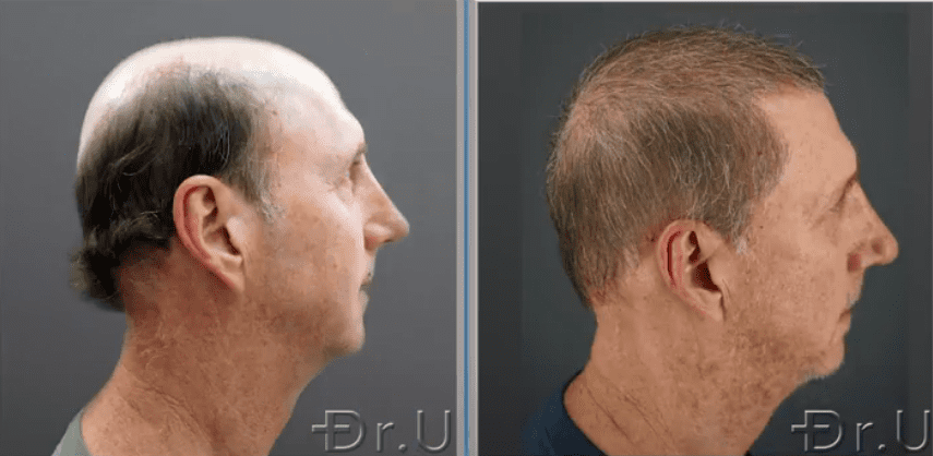 A side view of the patient's outcome shows an incredible improvement in his coverage after Dr UGraft Zeus severe baldness hair transplant