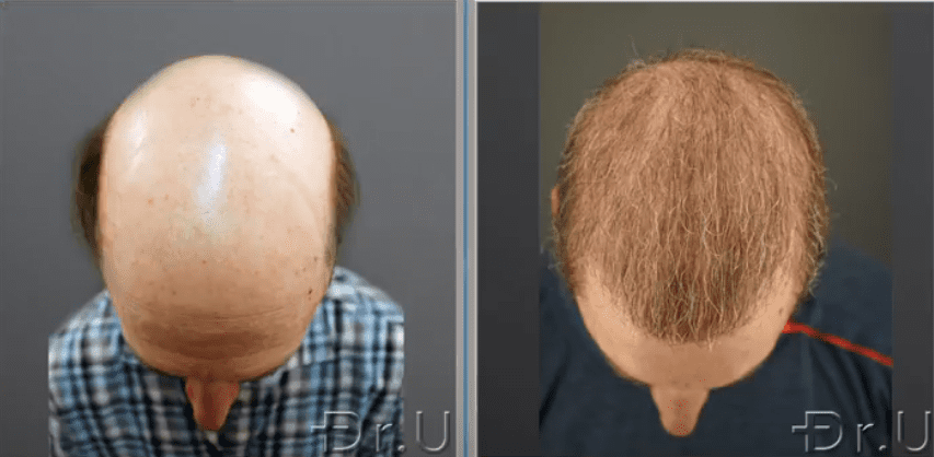The top of this patient's head is no longer bald thanks to the prolific growth of his donor grafts 