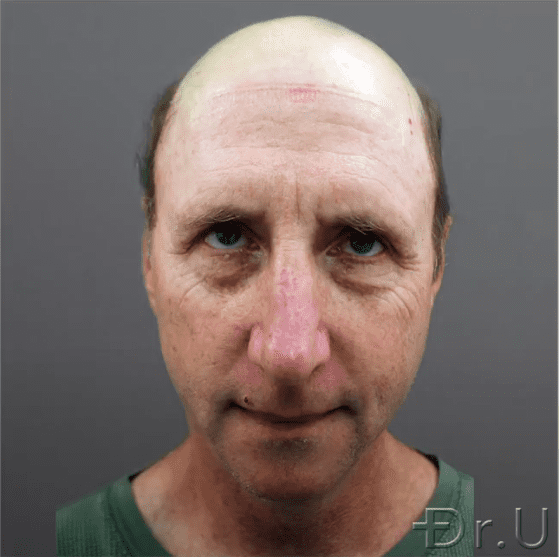 Front view of a severely bald patient who wishes to change his appearance through hair transplant surgery. 