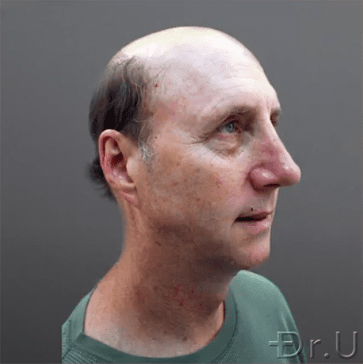 Side view of Dr.U's patient whose hair loss stage is worse than Norwood 7 