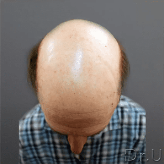 The top of the patient's head shows absolutely no hair growth