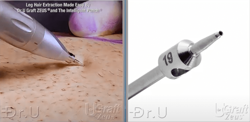 Dr.U busy at work, harvesting leg hair follicles using his Dr.UGraft Zeus technology and his Intelligent Punch*