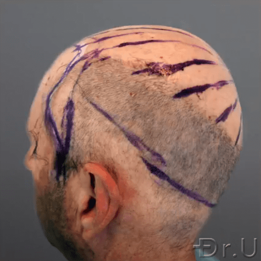 Dr.U marks off the directions and patterning of hair growth for this patient's final outcome*