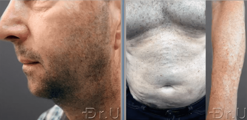 Donor hair was harvested from the hair transplant patient's face, torso, and arm